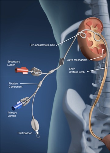 Figure 1 The stent is implanted in situ in human.