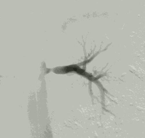 Figure 3 Conventional angiography image of the left renal artery after balloon dilation was performed.