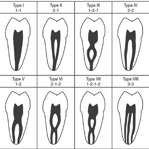 Figure 1 Diagrammatic representations of Vertucci’s classification for root canal morphology.