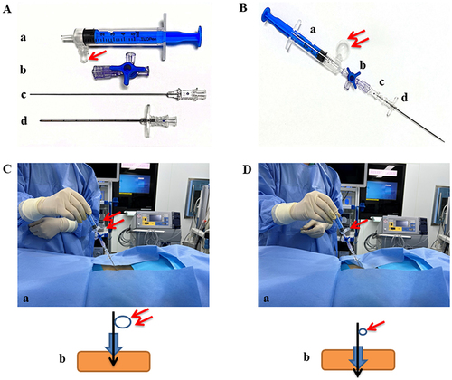 Figure 1 An injection kit composed of a disposable epidural syringe reflecting pressure (5 mL, (A-a and B-a)), a disposable triplet (5 mL, (A-b and B-b)), a disposable puncture needle for anesthesia (AN-SI, 0.7×106, (A-c and B-c)) and another disposable puncture needle for anesthesia (AN-E, 1.2×80, (A-d and B-d)) all from TUORen Medical Equipment Co., Henan, China (A and B). When the air bubble of the syringe (A-b and B-b) was shrunk during the kit was advancing, the puncture needle for anesthesia (AN-SI, 0.7×106, (A-c and B-c)) was withdrew. Then the ropivacaine mixed with dexmedetomidine was injected through the disposable puncture needle (A-d and B-d). The operation process and the flow diagram are as (C-A and D-A and C-b and D-b) of Figure 1, respectively.