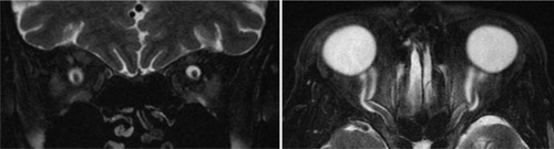 Figure 2 Axial (left) and coronal (right) fat-suppressed T2-weighted images of the orbits demonstrate enlarged CSF spaces around bilateral normal appearing optic nerve.