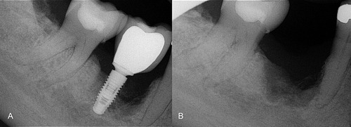 Figure 1 Initial radiograph (A) and after implant removal (B).