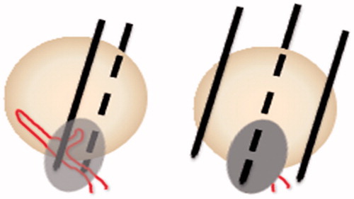Figure 2. Schematic diagram of percutaneous ablation of the tumor feeding artery. (Left) Two electrode needles were inserted parallel to the area where the artery entered the tumor. (Right) After blocking the feeding artery, the whole tumor was ablated.