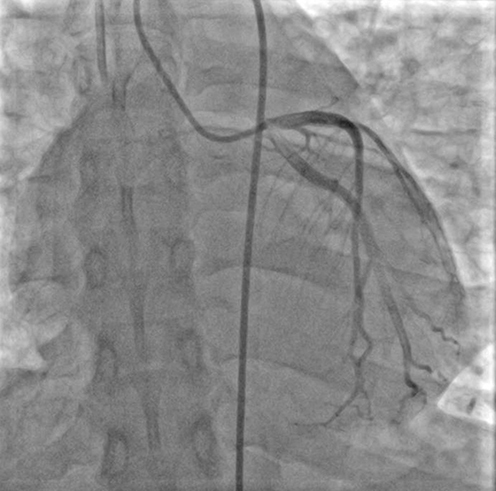 Figure 3 The Coronary angiography. Coronary angiography revealed that there was no stenosis or obstructive lesions in the coronary artery April 13th.