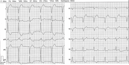 Figure 3 Representative ECG changes as also seen in the other family members (ECG from the uncle of the index patient).