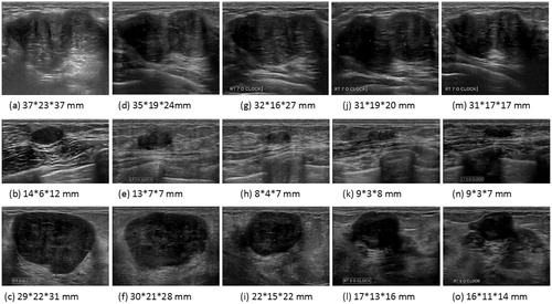 Figure 3. Ultrasound images of three patients showing change in volume over time; pre-treatment (a–c), 2 weeks (d–f), 3 months (g–i), 6 months (j–l) and 12 months (m–o) follow-up.