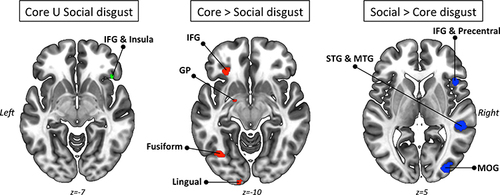 Figure 4 Conjunction and contrast analyses between core and social disgust processing datasets as performed by Gan et al.Citation61 Left panel: Convergence of activation between core and social disgust processing datasets (green color represents ALE values). Central panel: Compared to the social disgust dataset, activations are exclusively present in the core disgust dataset (red color represents ALE values). Right panel: Compared to the core disgust dataset, activations are exclusively present in the social disgust dataset (blue color represents ALE values).