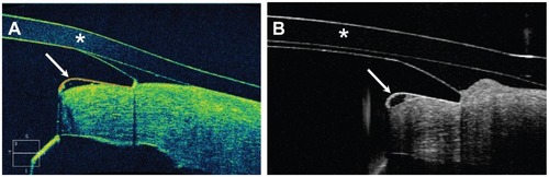 Figure 3 Imaging of the device-donor cornea interface with (A) the Cirrus HD-OCT and (B) the Spectralis Anterior Segment Module.