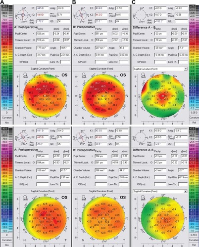 Figure 4 Scheimpflug imaging data showing comparison of 6 months postoperative data (A) versus preoperative (B), as well as the difference A–B (C), indicating the hyperopic refractive changes.