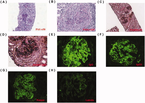Figure 1. Pathology of renal biopsy. (A) Light microscopy (LM) shows cellular crescent, PAS staining × 50. (B) Large cellular crescent formation, PAS staining × 400. (C) LM showed an MPGN pattern and full of crescents, PASM staining × 50. (D) Cellular crescent formation and compressed capillary loops, PASM staining × 400. (E) Immunofluorescence shows granular IgG deposition along the capillary wall and in the mesangial area (×200). (F) Immunofluorescence shows IgG subtype is IgG3. (G) Immunofluorescence shows granular κ light chain deposition along the capillary wall and in the mesangial area (×200). (H) Immunofluorescence shows negativity for lambda light chain (×200).