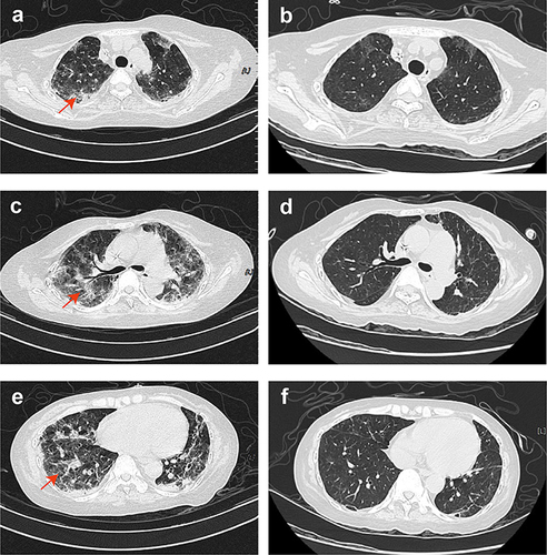 Figure 5 Serial chest computed tomography scans of the patient during multiple-drug resistance treatment of secondary infection. (a, c and e) On day 28, multiple patchy shadows and stripe shadows (red arrow) in bilateral lungs before treatment; (b, d and f) on day 50, multiple patchy shadows and stripe shadows in bilateral lungs were absorbed after treatment.