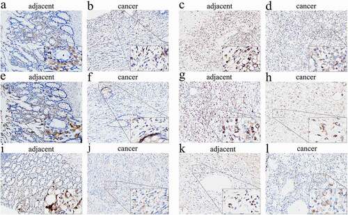 Figure 7. Immunohistochemical evaluation of CCR family protein expression in cancer and adjacent tissues. CCR2 in leiomyosarcoma (a) and synovial sarcoma (b). CCR4 in leiomyosarcoma (c) and synovial sarcoma (d). CCR5 in leiomyosarcoma (e) and synovial sarcoma (f). The expression of CCRs in tumor tissues is weaker than that in adjacent tissues in the same tumor at 200× magnification. The picture at the bottom right of each slice image is magnified 10 times again