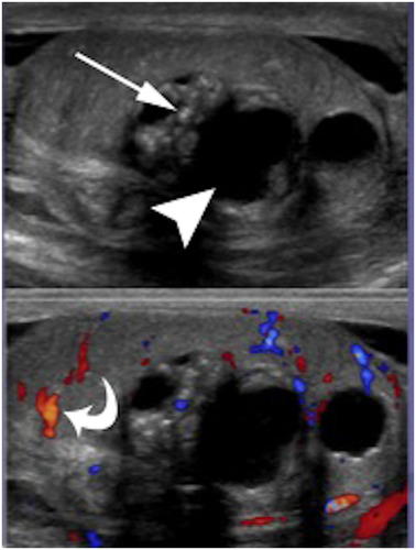 Figure 4 Nonseminomatous GCT: heterogeneous large oval intratesticular mass lesion with internal cystic and calcific changes. The mass also show internal hypervascularity.