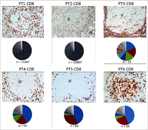 Figure 3. Localization of CD8+T cells and CD8+ TCR repertoire analysis in FL tissues. Immunohistochemical staining for CD8 (top) and TCRβ sequencing results of CD8+T cells (bottom) in pie chart pattern were combined to exhibit the correlation of CD8+ T-cell distribution and clonal diversity in 6 FL individuals. Colors display TCRβ sequences by sequencing counts with hierarchy; n = clone number by identified TCRβ sequences (in-frame reads). The detailed sequencing information of predominant clones in each data set is shown in Table S3. The average percentage of CD8+T cells is 10.47% ± 1.59% in total, with a standard error of 0.0065. Original magnification, ×200 for IHC pictures. IF, intrafollicular; PE, perifollicular.