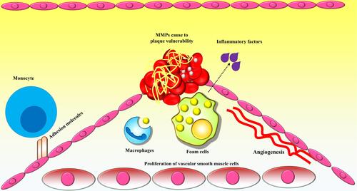 Figure 1 Schematic overview of the process of atherosclerosis. Monocytes infiltrate the inflammation site and differentiate into macrophages, which engulf the ox-LDL, and then develop into foam cells, which in turn increase the size and volume of atherosclerotic plaques. Foam cells, as well as other inflammatory immune cells present in atherosclerotic plaques, release several factors, among which extracellular matrix (ECM)-degrading enzymes such as matrix metalloproteinases (MMPs) contribute to the degradation of the ECM, resulting in loosening of the fibrous cap and plaque instability/rupture. Finally, atherosclerotic plaque rupture culminates in the development of a thrombus.