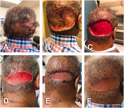 Figure 3. A 65-year-old male with history of AKN for at least 9 years. BMI 27 kg/m2. An 18 × 8 cm fluctuant AKN lesion on the occipital area with multiple ingrowing hairs, hemorrhagic crusts, cysts and purulent drainage from several sites. Fitzpatrick skin type 5. (A) Initial assessment in outpatient clinic. (B) Postoperative day 6 of 18 × 8 cm AKN excision. (C) Postoperative day 22; wound getting smaller, more superficial and well vascularized. Dark spot in the middle corresponds to overlying tissue of suture ligation of large arterial perforator. (D) Postoperative day 51; intraoperative view prior to skin graft procedure. (E) Initial dressing on day 6 after placement of split thickness skin graft. (F) Local condition one month after skin graft.