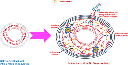 Figure 7 Putative mechanisms by which Th17 lymphocytes play a role in the pathogenesis of Takayasu arteritis. When compared with the native arterial wall, the arterial wall in large vessel vasculitis is thickened, with intimal proliferation, thickening of the media due to inflammatory cell infiltrate and adventitial fibrosis. T helper 17 (Th17) lymphocytes secrete the cytokine interleukin 17A (IL-17A) which attracts neutrophils to the media where they degranulate and release enzymes resulting in tissue destruction. Th17.1 lymphocytes secrete interferon gamma (IFN-γ) which contributes towards granuloma formation. Th17.1 lymphocytes also express p-glycoprotein and are resistant to corticosteroids. Programmed cell death 1 (PD1) positive Th17 lymphocytes secrete transforming growth factor beta 1 (TGF-β1) which in turn drives adventitial fibrosis.