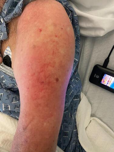 Figure 1 The patient’s upper arm showed erythema with no gross bleeding near the injection site
