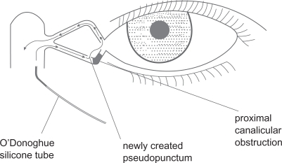 Figure 2 Diagrammatic representation of the modified retrograde dacryocystorhinostomy technique. O’Donoghue silicone intubation is performed, the stent being introduced through the common ostium, out through the pseudopuncum of the lower canaliculus and returned through the punctum of the normal upper canaliculus down through the common ostium into the nose.