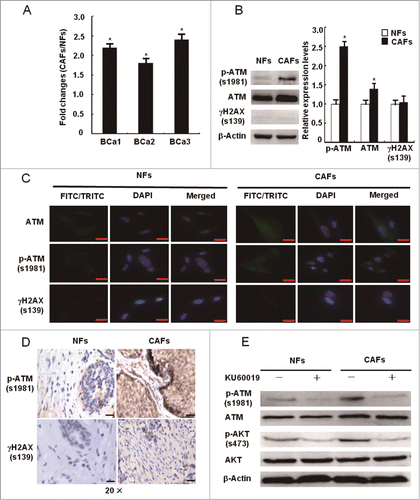 Figure 2. The activation of oxidized ATM independent of DSBs in CAFs. (A) The mRNA expression of the ATM gene was re-proved by qRT-PCR in CAFs and NFs derived from 3 breast cancer patients, and its relative fold changes in CAFs and NFs were presented. (*, P < 0.05). (B, C) The protein levels of total ATM, p-ATM (s1981), and γH2AX (s139) were analyzed by Western blot (B) and by immunofluorescence staining (C) in the immortalized NFs and CAFs. The relative fold changes of total ATM, p-ATM (s1981), and γH2AX (s139) in NFs and CAFs were displayed. Scale bars, 25 μm (*, P < 0.05). (D) The expression of p-ATM (s1981) and γH2AX (s139) in breast cancer specimens was analyzed by IHC staining. Scale bars, 50 μm. (E) The expression of p-ATM (s1981), ATM, p-AKT (s473), and AKT was determined by Western blot in NFs and CAFs in the presence or absence of KU60019 (5 μM) for 24 h.