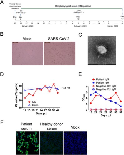 Figure 1. Clinical information and isolation of SARS-CoV-2 from a patient’s urine. (A) Clinical events. (B) Cytopathic effect (CPE) were observed in Vero E6 cells that were infected with SARS-CoV-2 isolate after 72 h but not in mock-infected cells. (C) Visualization of viral particles using Transmission Electron Microscopy (TEM). (D) Viral loads in respiratory and urine specimens. OS: oropharyngeal swab. (E) SARS-CoV-2-specific IgG and IgM antibody responses in patient. (F) IFA detection of SARS-CoV-2 infected Vero E6 using patient’s serum. No fluorescence was detected using healthy control serum or in mock-infected cells.