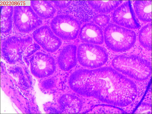 Figure 3 Pathological examination of the first colonoscopy biopsy.