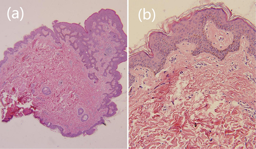 Figure 3 Histopathological findings. Epidermal hyperplasia and rete ridges extending downward in the shape of high-heeled shoes were seen with increased pigment in the basal layer. Hyperplasia of collagen fibers and fibroblasts were seen in the middle and lower dermal layer, mixed with histiocytes (H&E (a): 40x, (b): 100x).