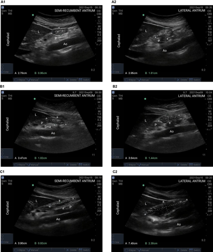 Figure 2 Gastric ultrasound performed based on the qualitative 3-point grade assessments. Antrum is pointed out by 4 x’s corresponding to its 2 perpendicular diameters. (A) The empty antrum (Grade 0) in the semi-recumbent (A1) and right lateral decubitus (A2) positions appear small and “flat”. (B) The antrum with minimal, insignificant amount of fluid (Grade 1), a small amount of fluid is detectable only in the right lateral decubitus position (B2). (C) The antrum with significant fluid content (Grade 2), fluid is evident in both positions, but more marked in the right lateral decubitus position (C2).