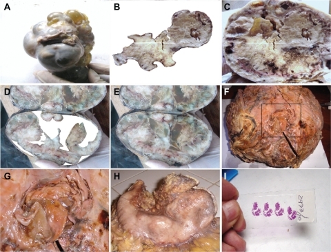 Figure 6 Macroscopic representation of an embryoid body. A is a macroscopic representation of a fractal embryoid body in a case of malignant ovarian tumor; B is a detachment subimage of C, a macroscopic representation of an embryoid body revealing a hexagonal geometric pattern and a crystal comet tail from a case of retroperitoneal malignant tumor; D is a detachment subimage of E, which is a macroscopic embryoid body representation from a case of renal cell carcinoma; F and G are macroscopic representations of fractal embryoid body structures from a case of leiomyosarcoma; H is a macroscopic representation of an embryoid body from a case of diffuse gastric cancer; I shows is an embryoid body from a case of squamous cell carcinoma of the skin, hematoxylin and eosin staining.
