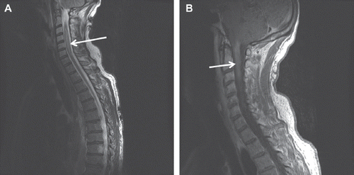 Figure 1. MRI of cervical spine, T2 weighted (A) and post-gadolinium T1 weighted (B) showing the bright lesion.