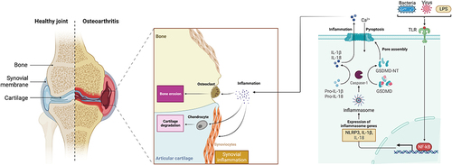 Figure 2 Mechanism of pyroptosis-mediated osteoarthritis. When certain signals, either inside or outside the cell, increase the expression of the NLRP3 inflammatory body, it triggers the cleavage of GSDMD and pro-IL-1β by caspase-1. This process produces GSDMD-NT which creates membrane pores that induce cytotoxicity and release inflammatory factors. In a prolonged chronic inflammatory environment, this can lead to synovial inflammation, osteophyte formation, cartilage degradation, and ultimately result in osteoarthritis.