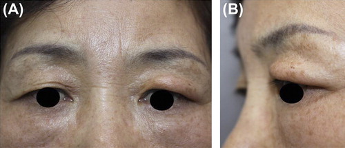 Figure 1. (A&B) A 74-year-old female presenting with edema and yellowish discoloration of the left upper eyelid which developed a month after an illegal filler injection to the forehead.