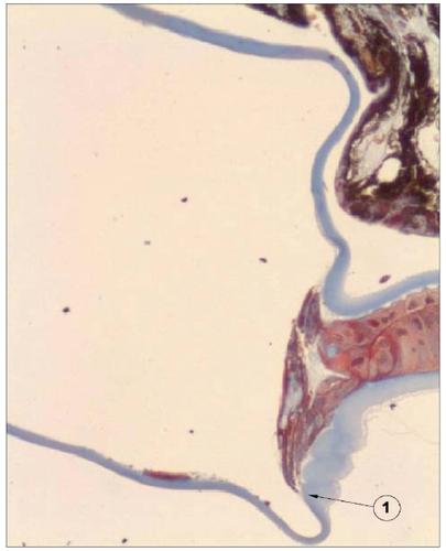 Figure 5 Photomicrograph of the anterior segment of an eye of the rabbit model. Note the effective barrier created by the sharp posterior edge of an Acrysof SA60 AT, reflecting the inhibition of cells’ growth (arrow). Note the thicker anterior capsule and the thinner posterior capsule. The IOL optic and haptics are dissolved out of the section, leaving a large space between anterior and posterior capsule.