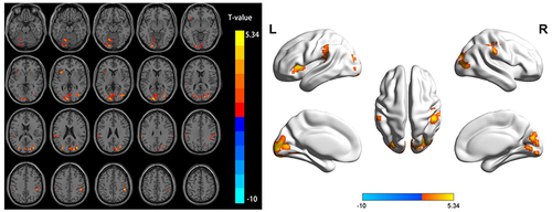 Figure 1 Differential brain regions of ALFF in the typical band between the AP and HC groups.