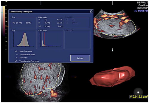 Figure 1. Placental blood flow measured by virtual organ computer-aided analysis software. Measures of blood flow obtained include the vascularization index (VI), flow index (FI), and vascular flow index (VFI).
