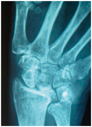 Figure 1: A plain anteroposterior X-ray of the patient’s right wrist.