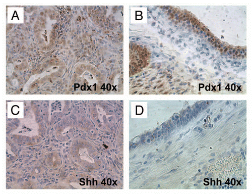 Figure 9 Hedgehog ligand is expressed by neoplastic glandular epithelium but not by the epithelium of non-neoplastic cysts. (A) and (B) Nuclear Pdx1, a marker of pancreatic progenitor cells not expressed in the mature ductal epithelium, is expressed within both neoplastic glands (A) as well as the lining epithelium of non-neoplastic cysts (B). (C and D) In contrast, Hh ligand, known to be overexpressed in most human PDAC, is expressed only by neoplastic glands (C) and not by the non-neoplastic cystic epithelium (D).