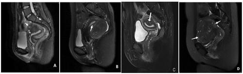 Figure 1. Classification of adenomyosis based on MRI. (A) Type I: the lesion invaded the endometrium layer, and the serosal layer (arrow) was intact; (B) Type II: the lesion invaded the outer uterine layer, the endometrium and the junctional zone (arrow) were intact; (C) Type III: lesions (arrows) confined to the myometrium with intact uterine structure; (D) Type IV: lesion (arrow) invaded the whole uterus.