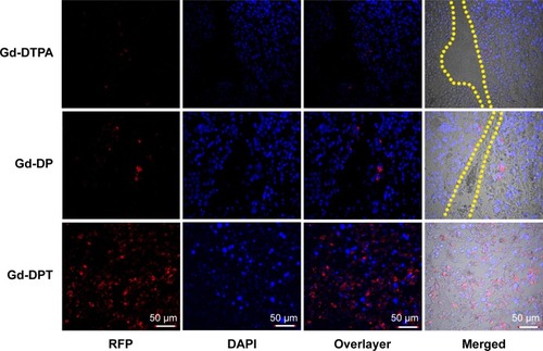 Figure 6 Confocal luminescence microscopy showing the in vivo distribution and amount of RFP expressed after transfection by naked plasmid or nanoparticles. Upper panel shows Gd-DTPA/pRFP (Gd-DTPA), middle panel shows Gd-DP/pRFP (Gd-DP), and lower panel shows Gd-DPT/pRFP (Gd-DPT). Red indicates RFP, blue indicates DAPI-stained cell nuclei, and yellow lines indicate crevices in tumor tissue. Original magnification 200×.Abbreviations: Gd, gadolinium; DAPI, 4,6-diamidino-2-phenylindole; pRFP, plasmid red fluorescence protein; DGL, dendrigraft poly-L-lysine; PEG, polyethylene glycol; DTPA, gadopentetate dimeglumine; DP, DTPA-DGL-PEG; DPT, DTPA-DGL-PEG-TAT.