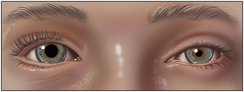 Figure 7 Partial Horner’s syndrome of the left eye; ptosis and miosis.