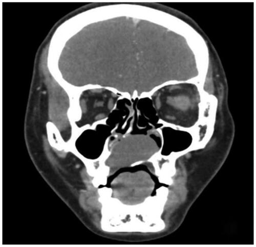 Figure 2. CT shows round-like swelling changes from the palatine bone to the base of the nasal septum.