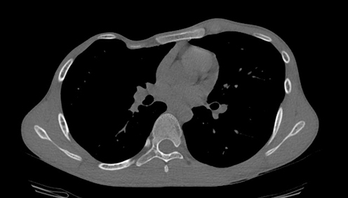 Figure 2 CT of thorax before operation.