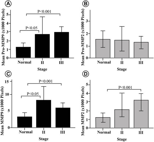 Figure 7 Stage-specific differences of MMPs in human breast cancer patients. (A) Pro-MMP-9 significantly higher in stage II and III compared to normal tissue. (B) Pro-MMP-2 does not show any significant change across the stages. (C) MMP-9 significantly increased at stage III and II compared to normal tissue. (D) MMP-2 significantly increased between stage II and normal tissue. All values are presented in pixel mean ± SEM, times 1000 (n = 36).
