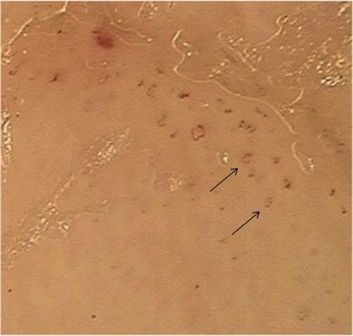 Figure 5 Dilated tortuous vessels of hyponychium with dermoscopy (original magnification: ×40).