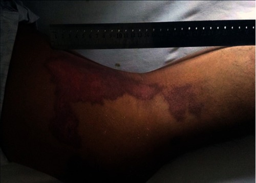 Figure 7 Skin necrosis after intra-arterial infusion of cisplatin.