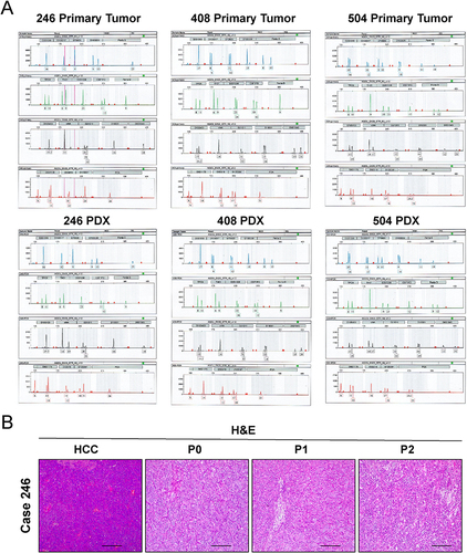 Figure 2 Authentication of PDX models with primary tumors by short tandem repeat analysis. (A) STR profiles of primary tumor (Case 246, Case 408 and Case 504) and PDX models (Case 246, Case 408 and Case 504) are shown. (B) Representative photomicrographs of H&E staining in case 246. The photomicrographs were captured using the Leica DM 4000 microscope (Leica). Scale bar is 200 μm.