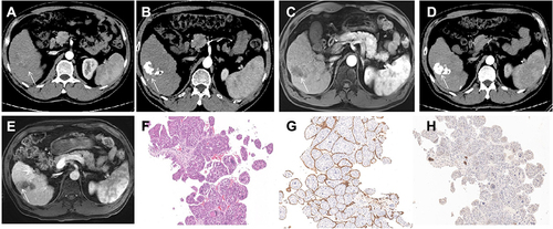 Figure 4 Images in a 49-year-old man (case 100) with S5 VETC, MTT, and CK19-negative HCC, BCLC A stage and baseline serum AFP level of 1671 ng/mL. (A), baseline HAP image (5.2cm, white arrow); (B), HAP CT, and (C), HAP Gd-EOB-DTPA MRI after the first session of cTACE: compact and >50% lipiodol deposition without alive lesion (white arrow), tumor response is CR according to mRECIST; (D), HAP CT, and (E), HAP Gd-EOB-DTPA MRI: lipiodol deposition was stable and remained CR after 15 months (white arrow); (F), macrotrabecular growth pattern was seen; (G), HCC was VETC according to CD34 IHC; H CK19 was negative (×40 magnification). HAP: hepatic artery phase.