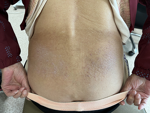 Figure 1 Erythema, papules, scales and excoriation on the waist.
