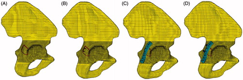 Figure 2. Fracture models. (A) Fracture component without any fixation systems, (B) the first fixation system: Linear two-lag screws configuration, (C) the second fixation system: single reconstruction plate with two-lag screws, (D) the third fixation system: single reconstruction plate with T-shaped mini-plates.