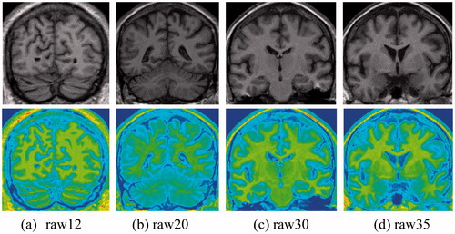 Figure 1. Brain MR images and their corresponding pseudo-color images.